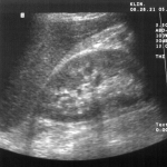 Qu’est-ce qu’une échographie abdominale et comment se déroule-t-elle ?