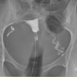 douleur hysterographie