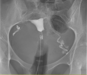 douleur hysterographie