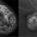 mammographie-douleur