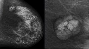 mammographie-douleur