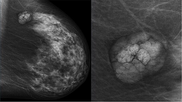 mammographie-douleur