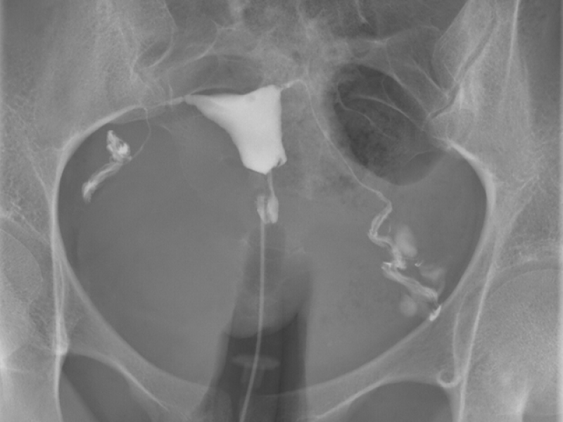 douleur hysterographie